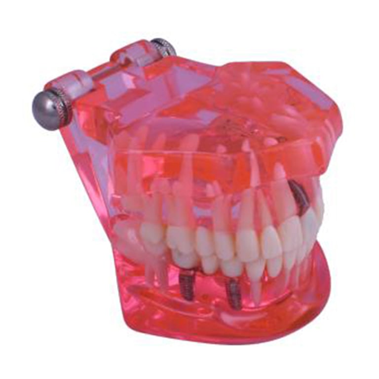 3D Dental Educational Restoration Tooth Model, 1Pk. Full-size hinged dental model featuring