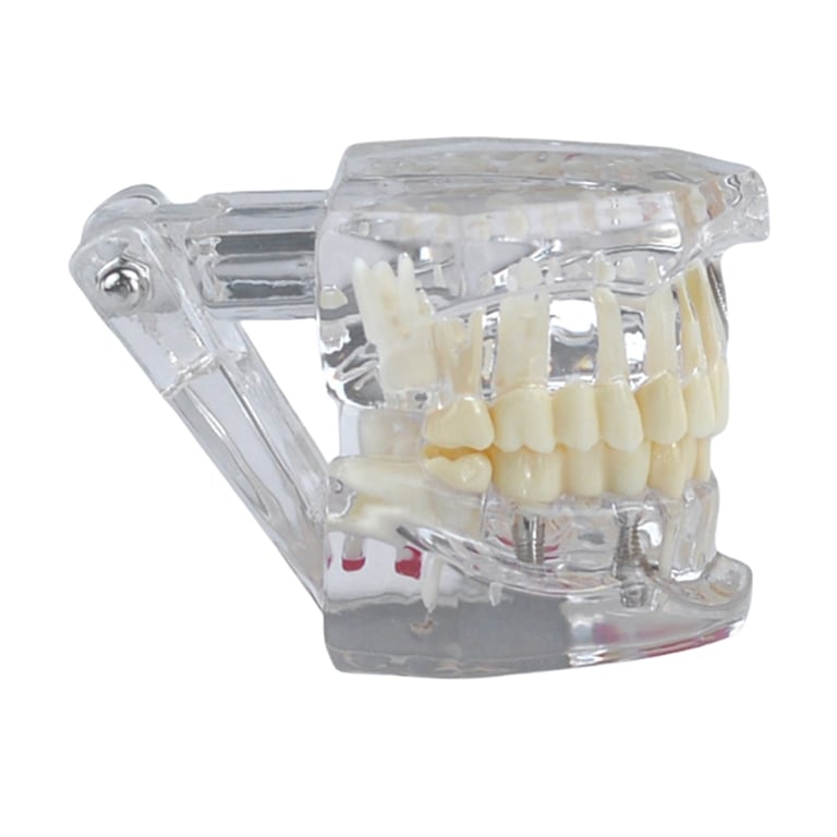 3D Dental Educational Restoration Tooth Model, Clear, 1Pk. Dental model featuring implants