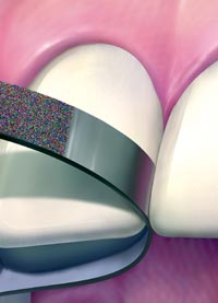 NTI Diamond Strips 2.5 mm MEDIUM. Single-sided. Package of 10 Strips