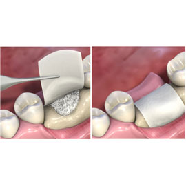 MatrixDerm EXT regenerative collagen dental membrane 20mm x 30mm, 1/Box. White, non friable