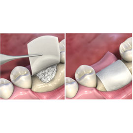 MatrixDerm regenerative collagen dental membrane 15mm x 20mm, 1/Box. Has enhanced characteristics