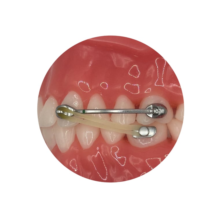 Ortho Shop DMD Appliance Elastics, Force 1, 1/4", 6 oz, 1000/Pk. Designed for use with the DMD