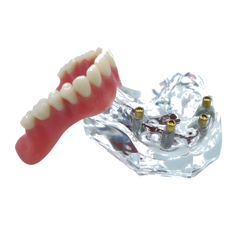 Seum Medi Upper Overdenture Jaw Model, Clear Arch w/4 Implants, 1/Pk. Includes a transparent