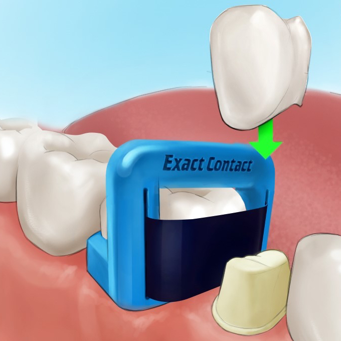 EXACT CONTACT crown insertion device - Pack of 20 EXACT CONTACT crown insertion device - Pack of 20