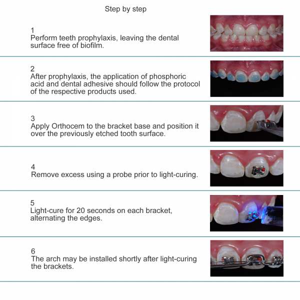 Orthocem Light-Curing Orthodontic Cement 4g Syrin Orthocem Light-Curing Orthodontic Cement 4g Syrin