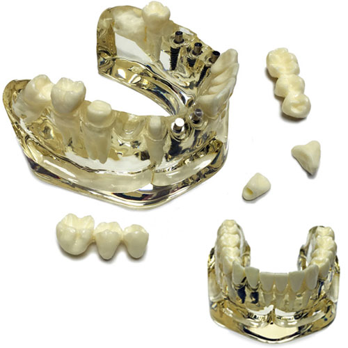 BesQual Implant Model, Oversize Lower. 4.75" x 4. BesQual Implant Model, Oversize Lower. 4.75" x 4.