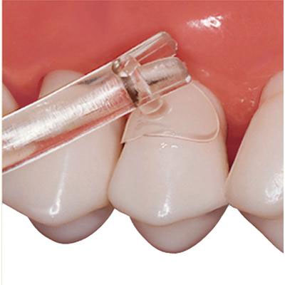 Cure-Thru Cervical Matrices Cure-Thru Placement I Cure-Thru Cervical Matrices Cure-Thru Placement I