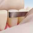 Premier Compo-Strip 200T2 - For Orthodontic Repro Premier Compo-Strip 200T2 - For Orthodontic Repro